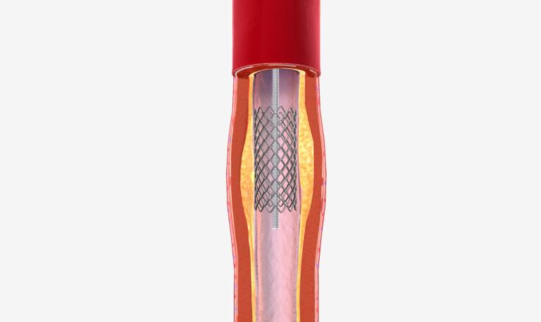 angioplastia coronariana