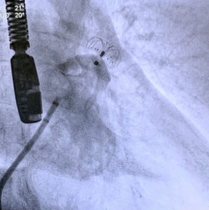 oclusão do apêndice atrial esquerdo