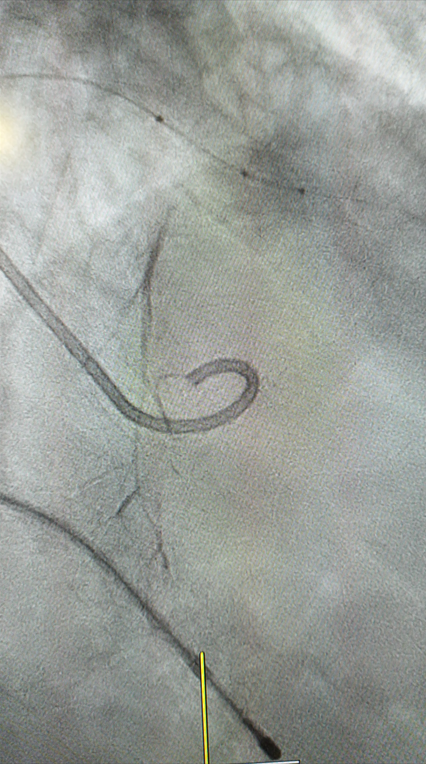 abração septal