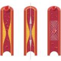 Molinhas ou Stents nas Coronárias: Angioplastia Coronariana