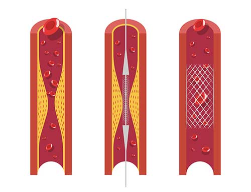 stents