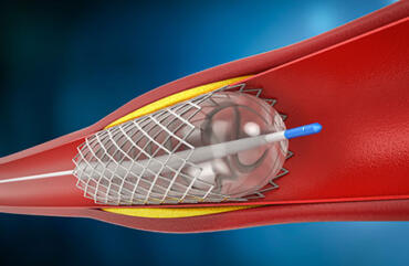 angioplastia