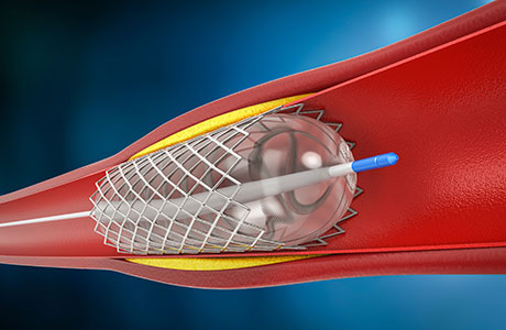 angioplastia